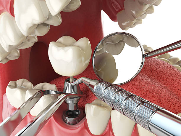 Best Emergency Denture Repair in Navesink, NJ